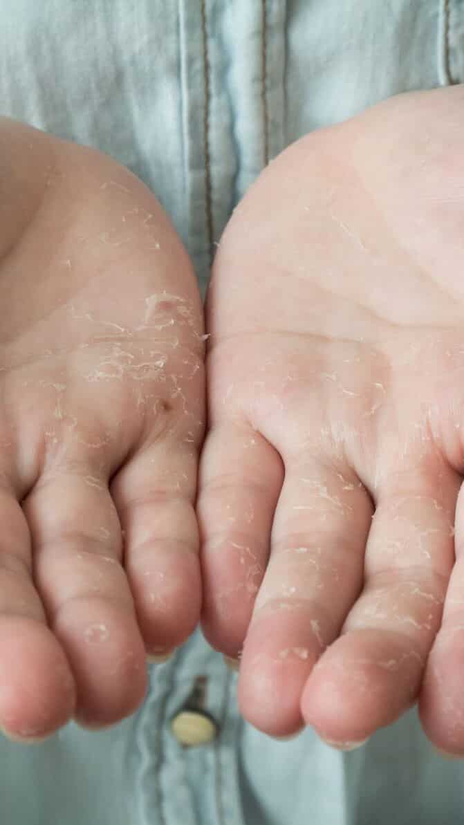 6 Ways to Get Rid of Peeling Fingertips