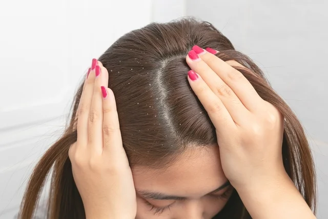 4 Ways To Use Camphor To Get Rid Of Dandruff
