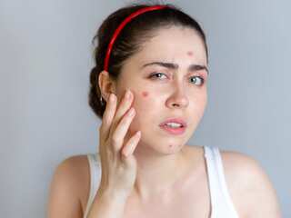 5 Food Items That Can Cause Acne
