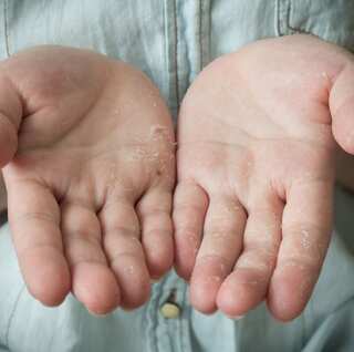 6 Ways to Get Rid of Peeling Fingertips 