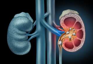 Five Tips to Help Prevent Kidney Stones in Children