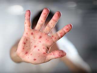 5 Symptoms of Measles