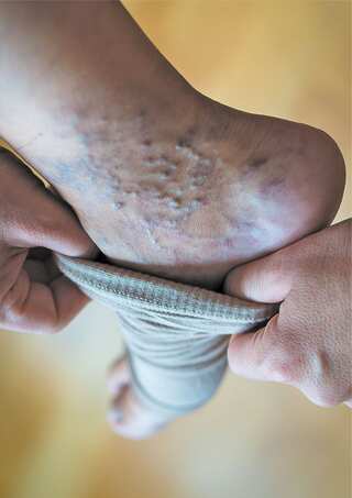 5 Juices That Provide Relief In Varicose Veins
