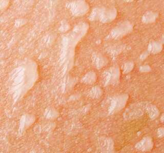 5 Natural Home Remedies to Treat Blisters