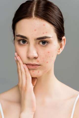 5 Tips to Avoid Hormonal Acne
